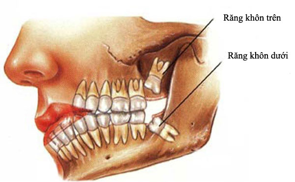 Răng khôn, giữ hay nhổ?